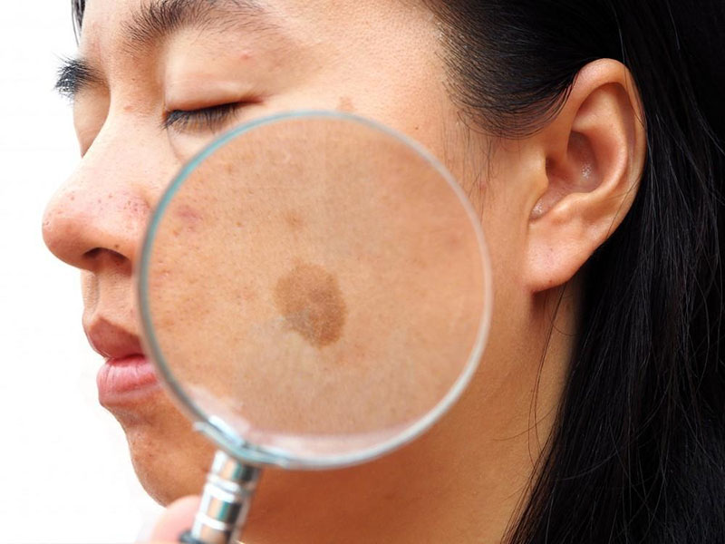 Picosekund laser: en bra hjälpare för att ta bort melasma