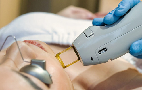 Varför mer och fler kund väljer Alexandrite Laser för att göra hårborttagningen?