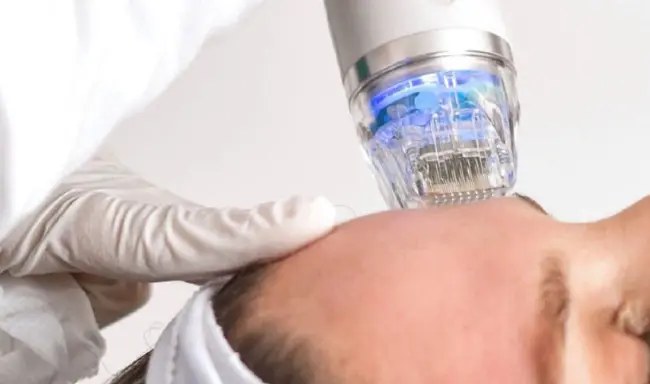 Vilka är fördelarna med RF microneedling behandling?